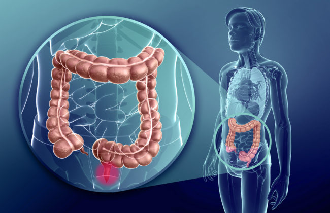 cancer-colorretal Alimentação e Câncer Colorretal